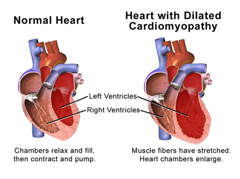 what causes dilated heart function